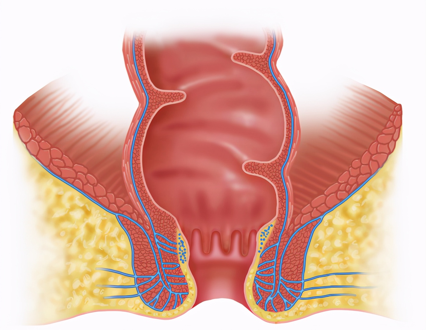 屁眼持续疼痛,不一定就是痔疮肛裂,肛管炎了解一下