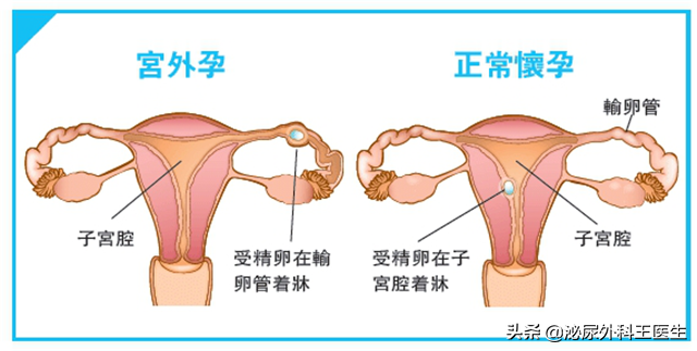 T型环上环是过程怎样的？上环后多久到医院复查？医生告诉你