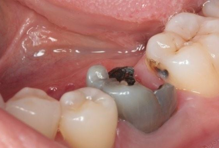 因为龋齿而出现了小黑点,一般可以根据其发展程度不同进行划分.