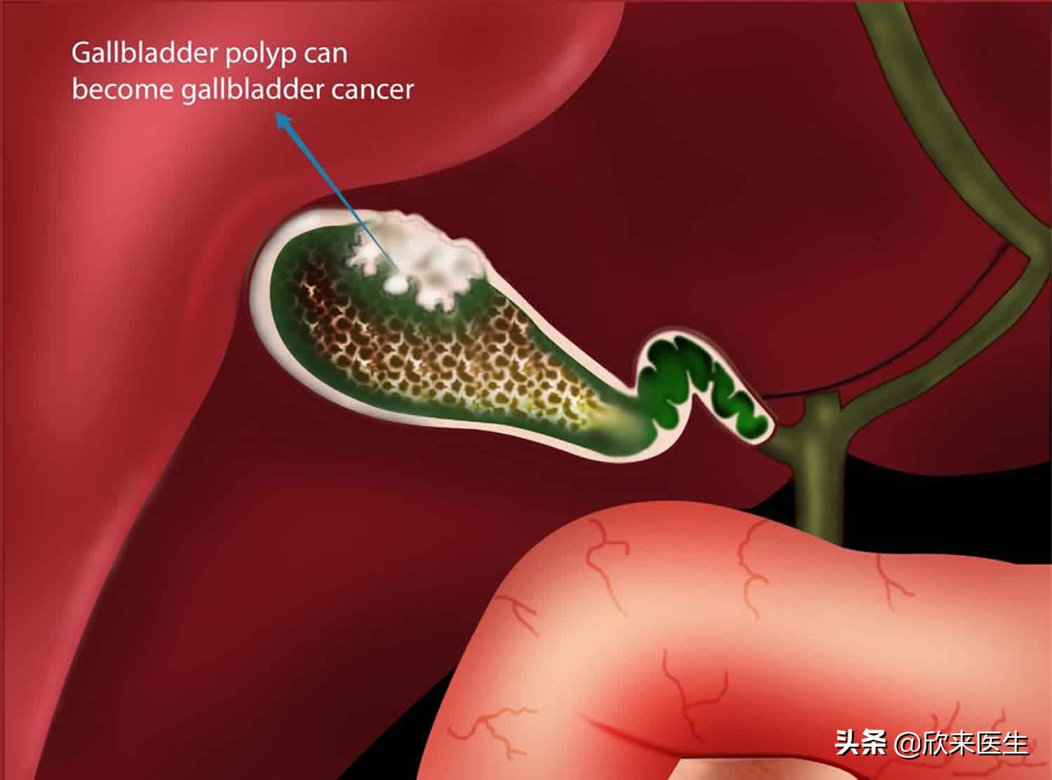 体检查出胆囊息肉严重吗，该怎么处理？