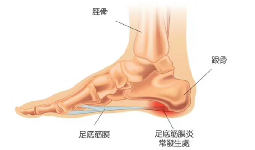 脚后跟痛，不要觉得忍忍就好！医生告诉您：可能和3种病有关