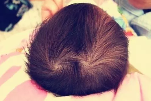婴儿双旋是怎么形成的(为什么有的孩子头顶有2个) - 乐宝宝贝