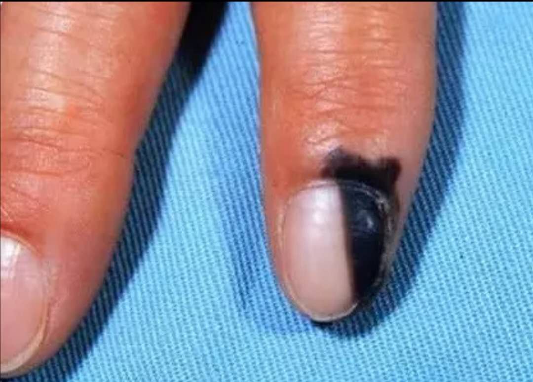 黑指甲是怎么造成的图片