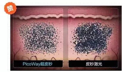 皮秒+蜂巢皮秒+超皮秒,搞了半天区别居然是这样的~