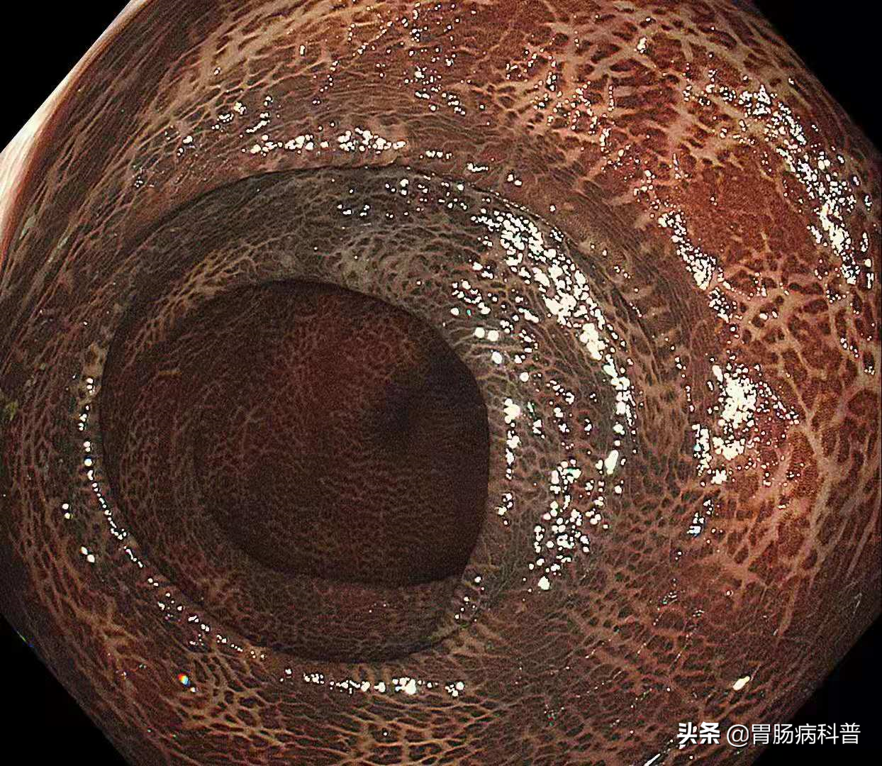 因为便秘长期喝泻药,结果悲剧了——不但大肠变黑了,还发现早癌