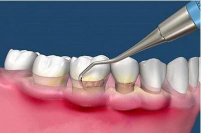 什么是龈下刮治？治疗过程疼吗？会打麻药吗？专业牙医告诉你