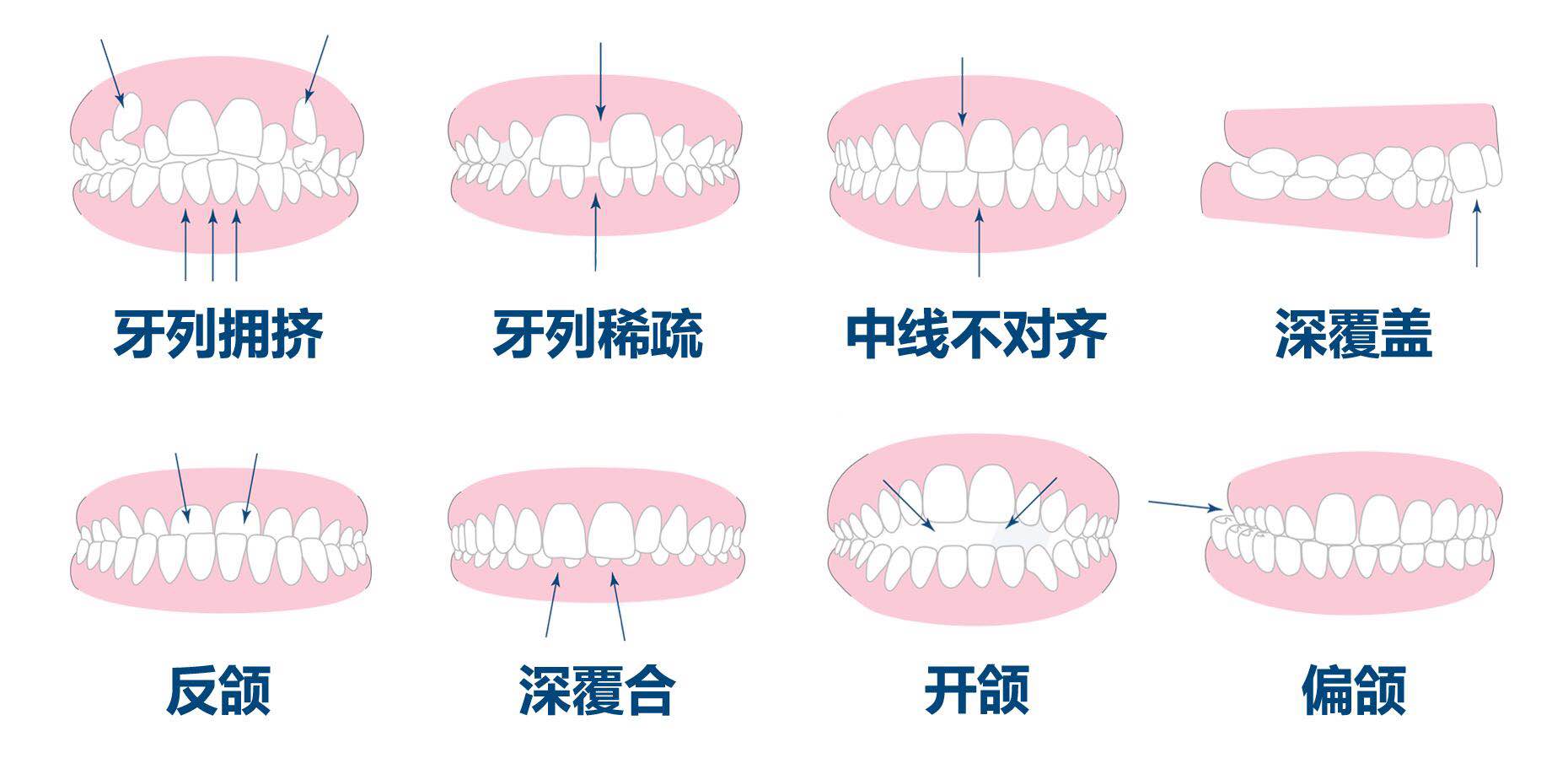 2,口腔的不良习惯(例如婴幼儿的咬手指,咬上下唇等 3,牙龈疾病,急性