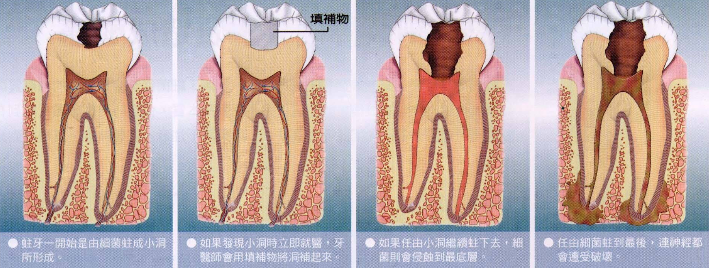 牙齿烂了之后，补牙后医生建议要戴牙冠，真的有必要吗？