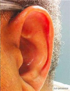 耳垂上的皱纹还能反应冠心病严重程度，它不仅仅就是一条普通的沟