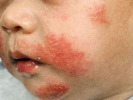 宝宝湿疹通常表现是皮肤有大面积发痒红疹.