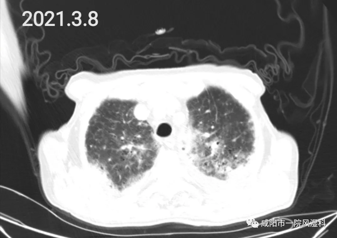 全程C反应蛋白升高是怎么回事？——咸阳市第一人民医院解析