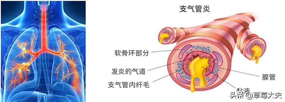 孩子咳嗽老不好，可能是因为这病“不好认”