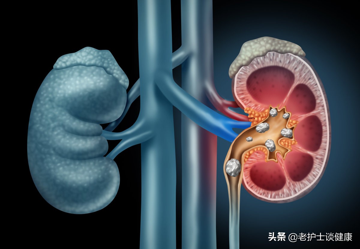 肾结石剧痛难忍，不知道该怎么办？别慌，老护士教你5招