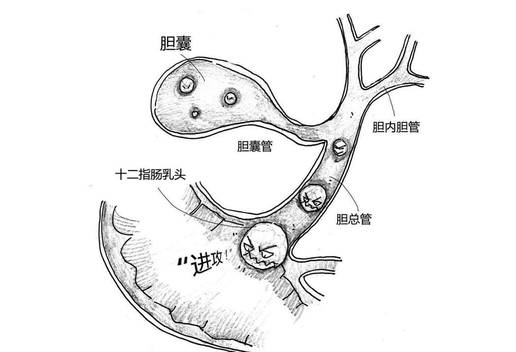 根据结石所在部位,胆石症可分为胆囊结石,肝内胆管结石及胆总管结石