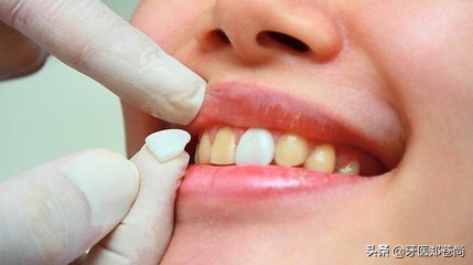 牙齿贴面能维持多长时间？