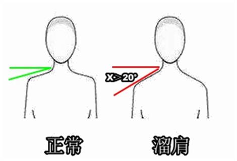 肩胛骨突出驼背图片(斜方肌肥大是溜肩的罪魁祸首) - 赤虎壹号