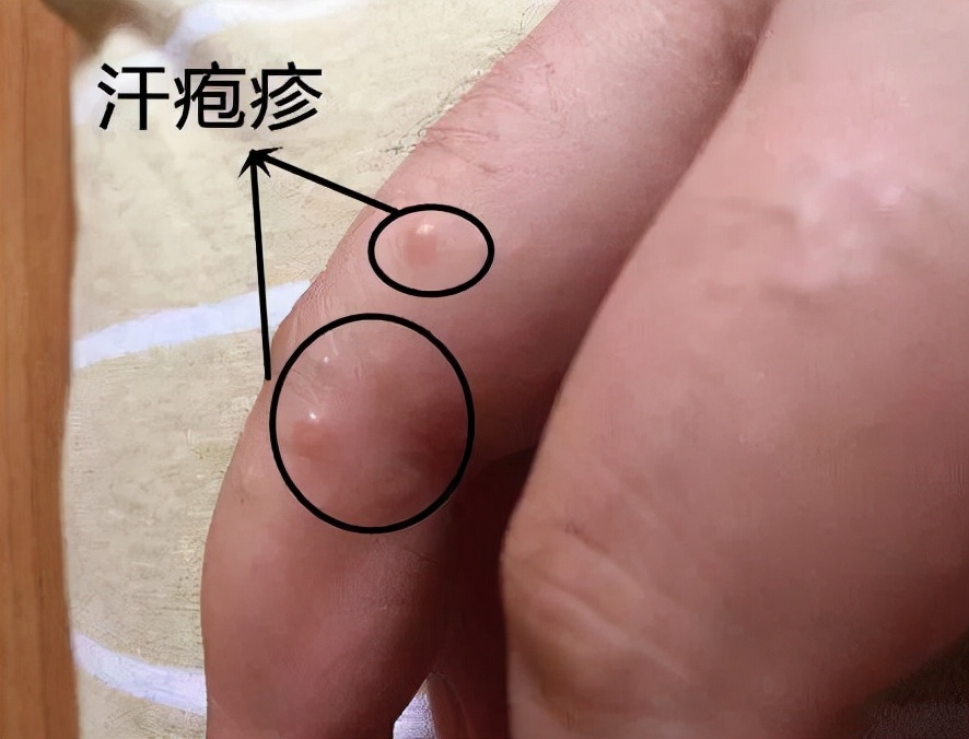 湿疹,汗疱疹很痒很难受?教你几个方法,轻松摆脱它们