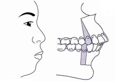 严重龅牙不仅影响美观，更影响咬合引发各种问题，牙医教你怎么治