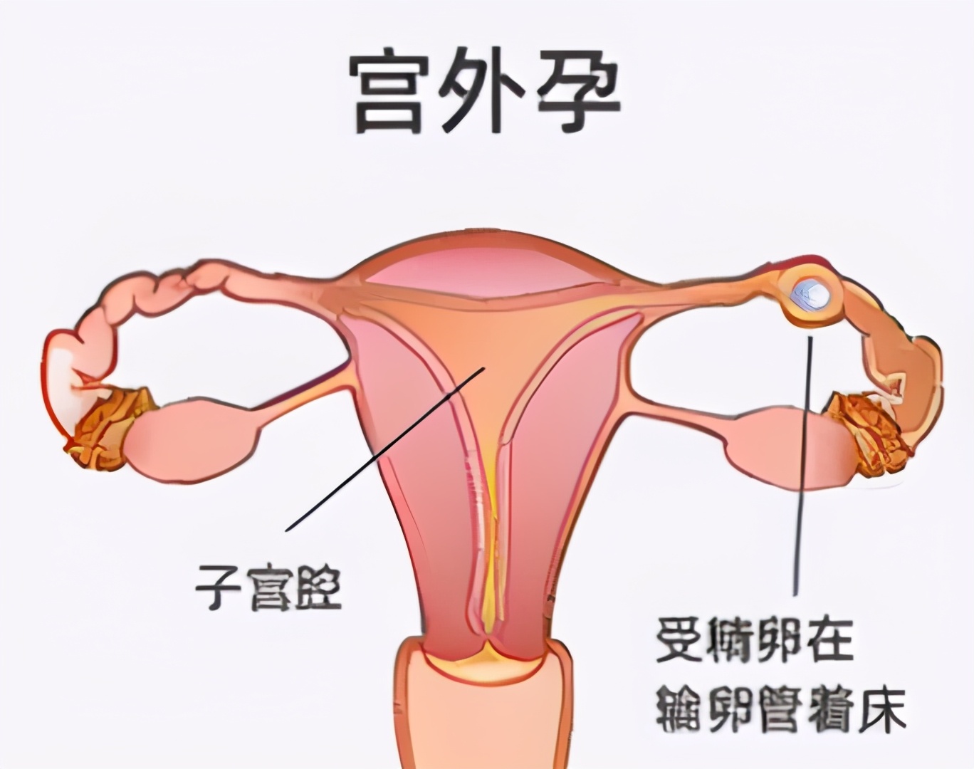 宫外孕有哪些征兆表现？是什么导致了宫外孕