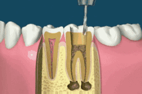 深龋牙髓炎可以补牙治疗吗？