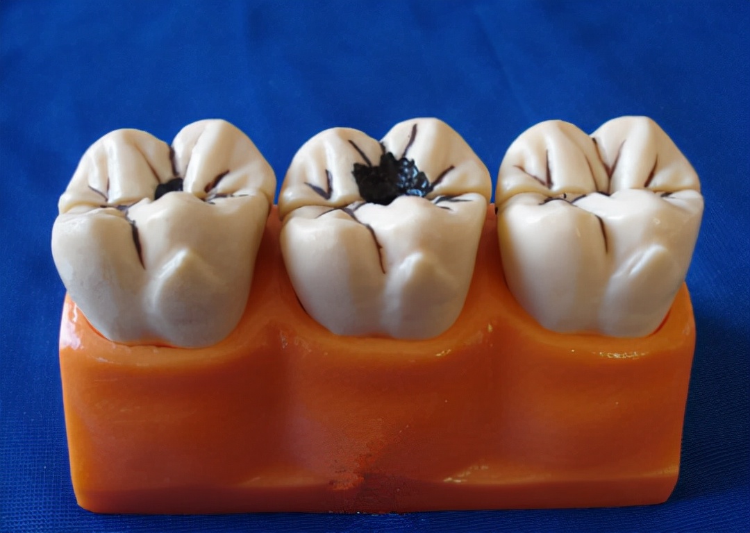 正常情况下,龋齿是这样的一个发展过程