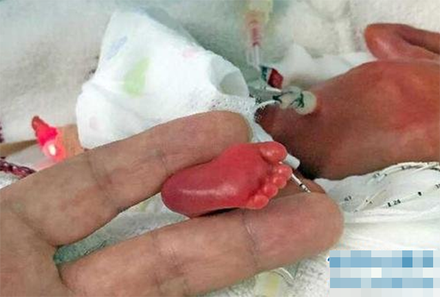 胎儿早产多少周能存活(24周超早产儿出院) - 青木春