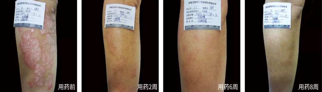 银屑病重磅新药欣比克，使用后的效果究竟怎么样？临床数据告诉你