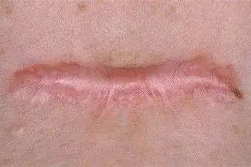 凹陷和凸起，疤痕为什么会产生不同？