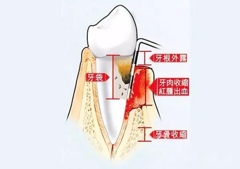 洗个牙要2000+ 不是说洗牙很便宜的吗？我这是被坑了吗？