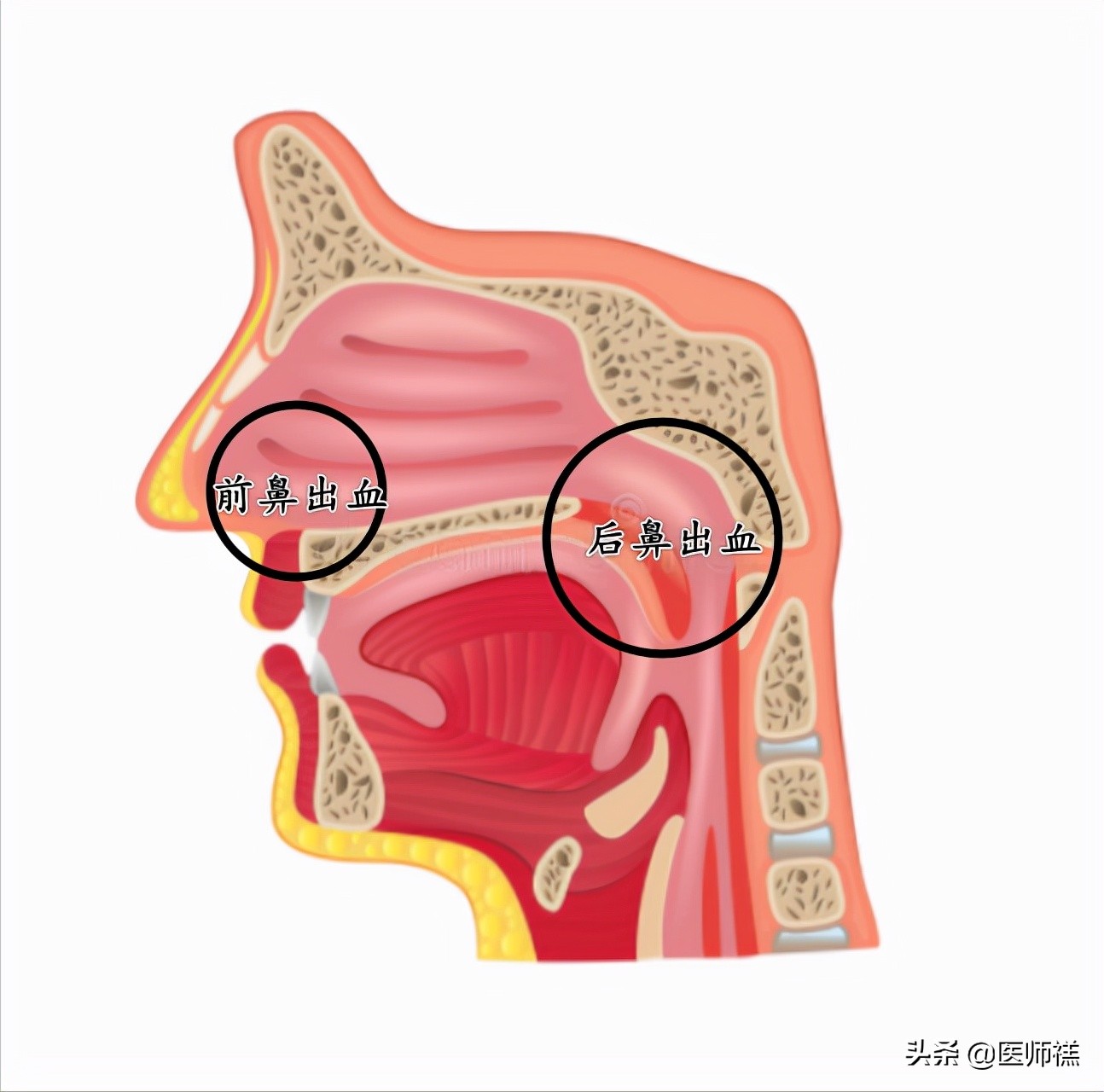无缘无故流鼻血？以下一些健康问题，医生希望你一定要明白
