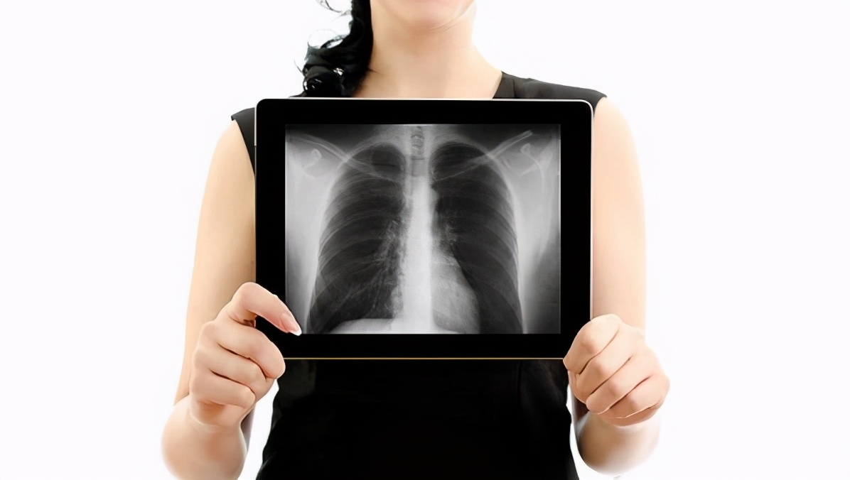 胸片中的“肺纹理增粗、肺纹理增重”是什么意思？严重吗？