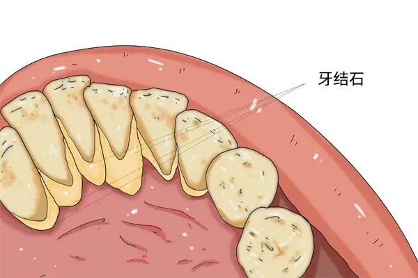 牙线是什么（使用牙线牙缝会变大吗）