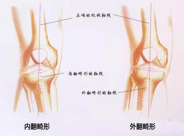 膝外翻或膝内翻到底是什么什么是膝外翻和膝内翻