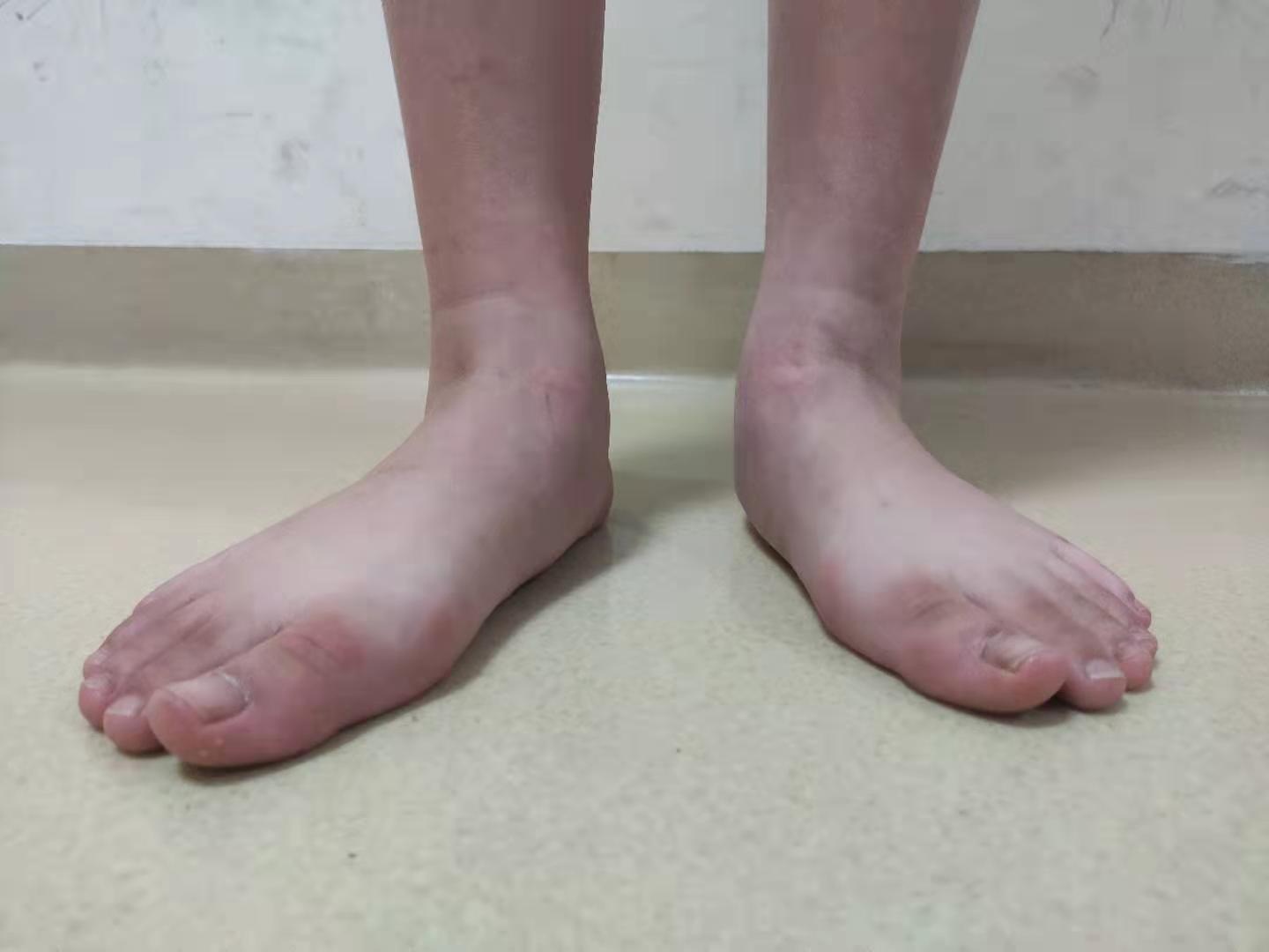 右腿小腿肚酸痛是怎么回事(经常有患者问) - seo葵花宝典