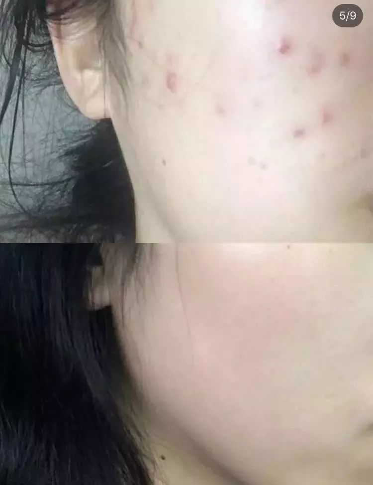 脸上泛红发痒、出油长痘？“螨虫脸”真的很丑，除螨刻不容缓