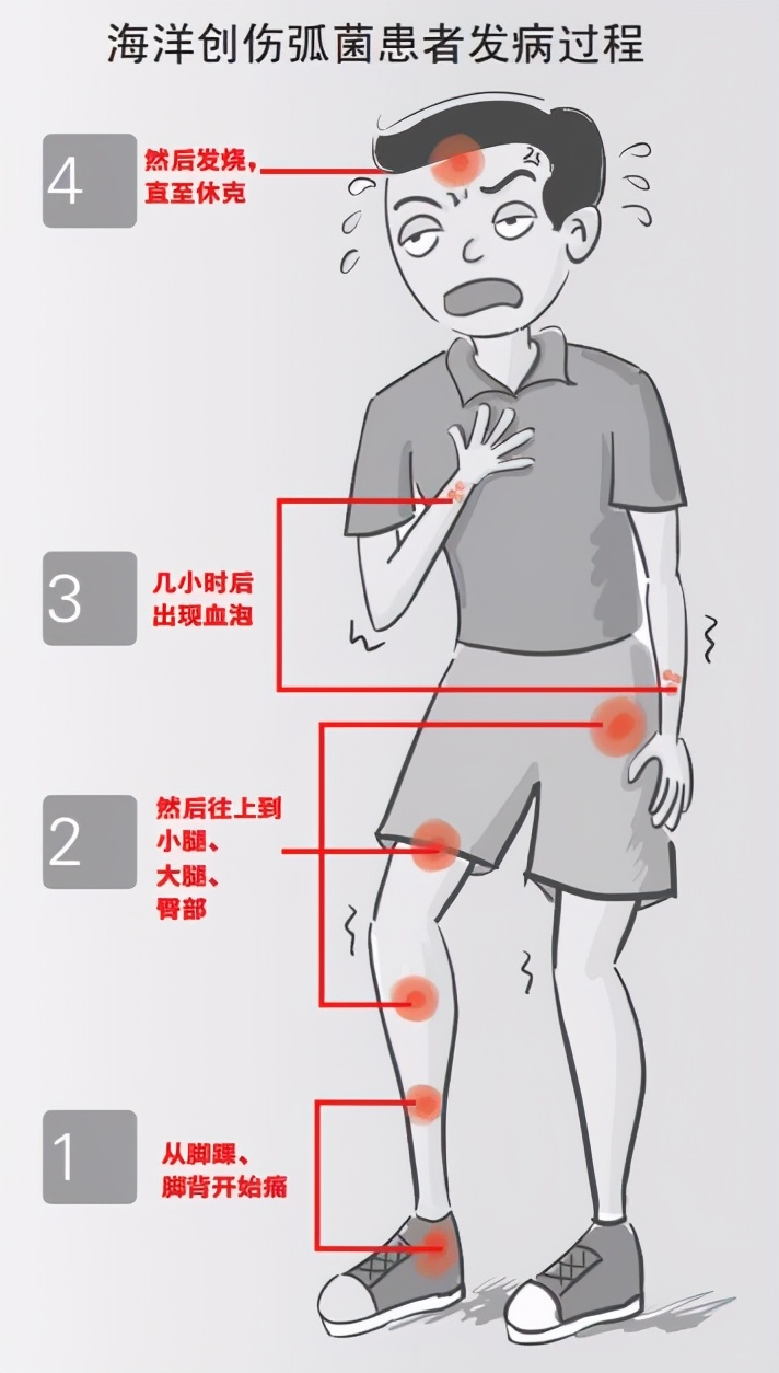 男子手指被鱼刺扎伤，不得已截肢保命！海鱼的刺为何如此致命？