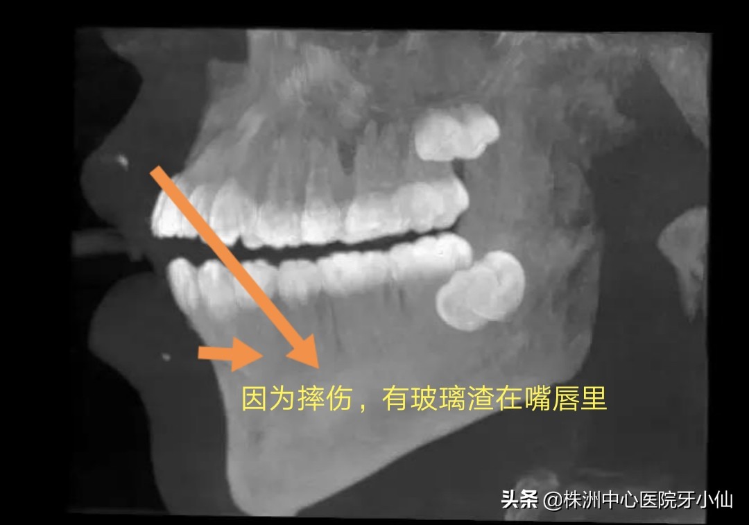 看个牙还需要拍CT？是真的有用，还是多此一举？#清风计划#