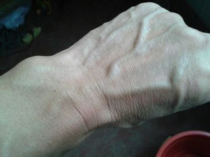 辟谣:手上青筋凸起,是毒素淤积吗?医生说出真相,很多人不知道