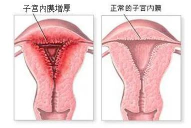 子宫内膜增厚怎么回事？子宫内膜增厚的危害有哪些？