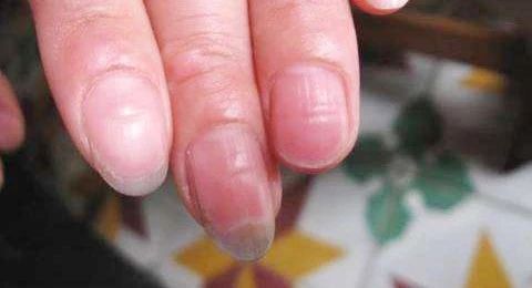 如果短期内出现指甲不平整,容易折断,所以可以适当补充一些维生素a,如