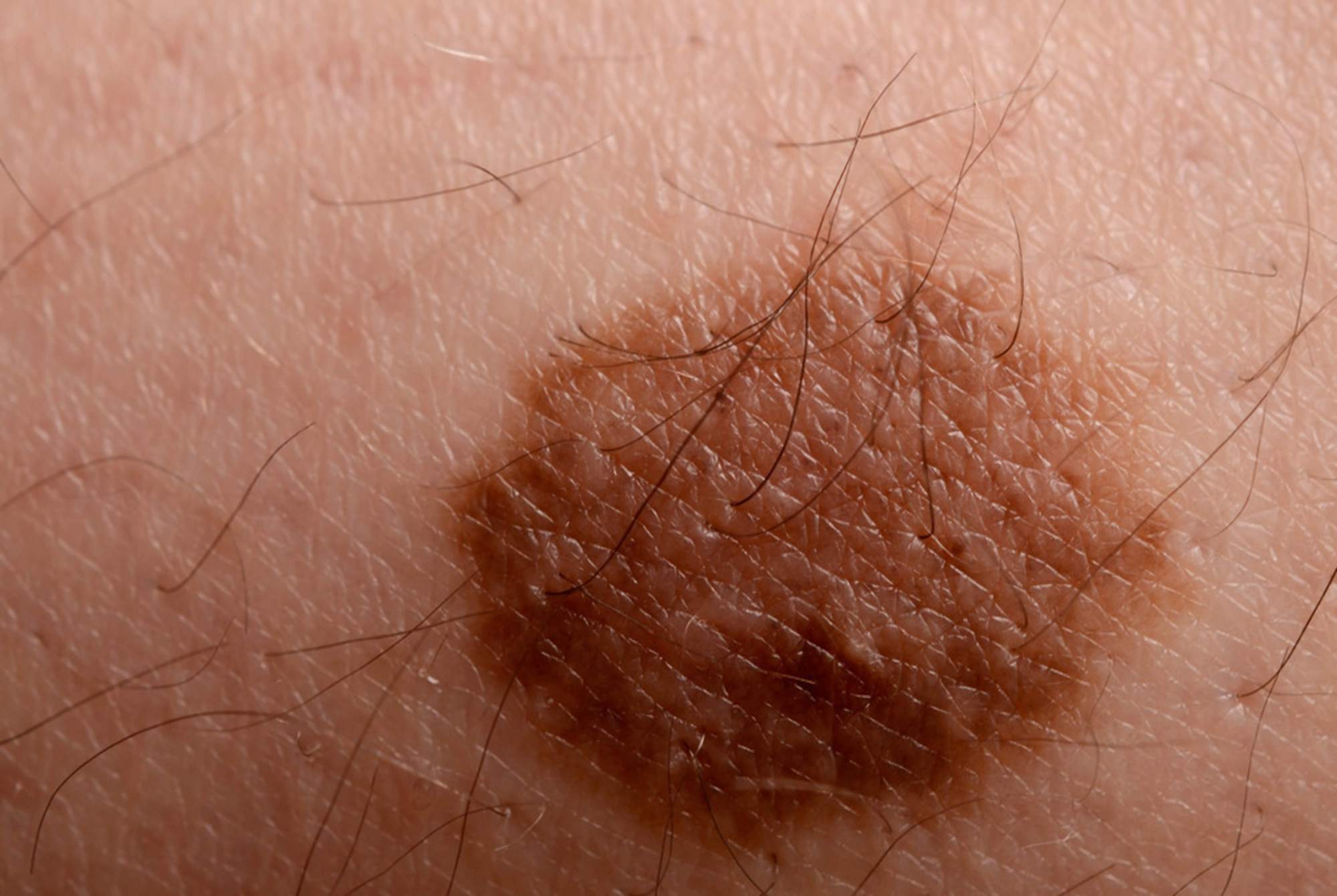 新生儿额头现"心形胎记",天使之吻还是恶魔印记?要能分得清