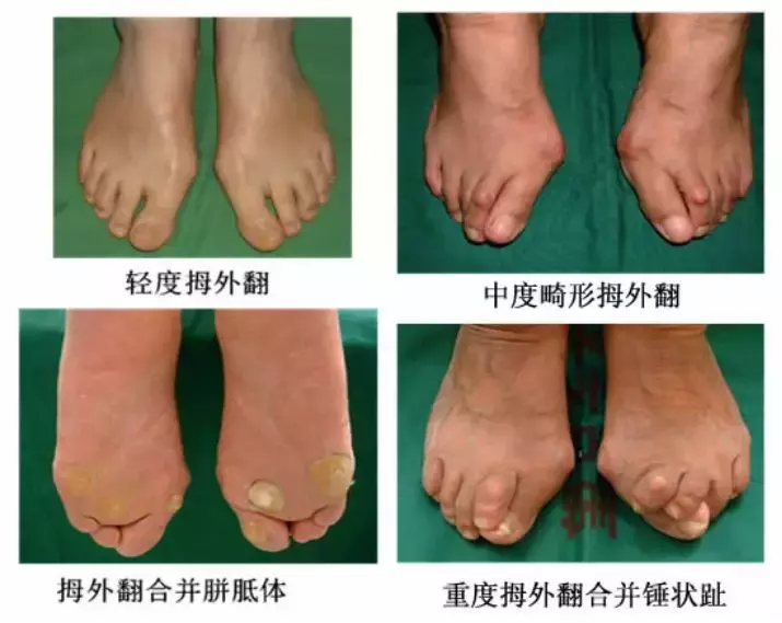 案例:轻度拇外翻不治疗,拖延20年成重度,疼痛难忍才来手术