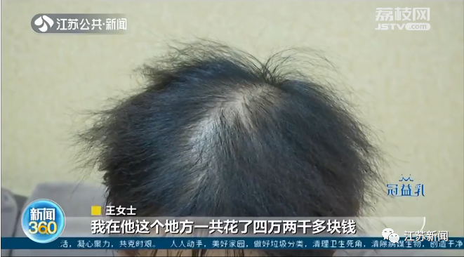 35岁就“秃了”，她花了4万元植发，植发真能“一劳永逸”吗？