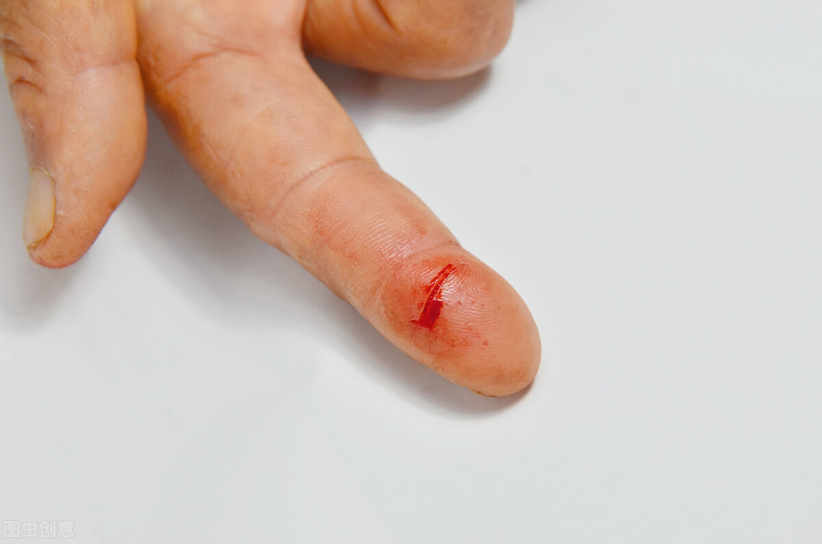 破碎手机膜"扎"进手指,却检查出瘤?
