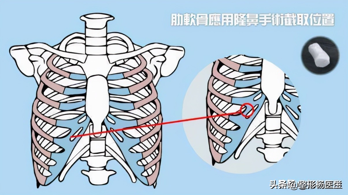 隆鼻失败了会怎样？一文了解隆鼻的各种风险与避坑攻略