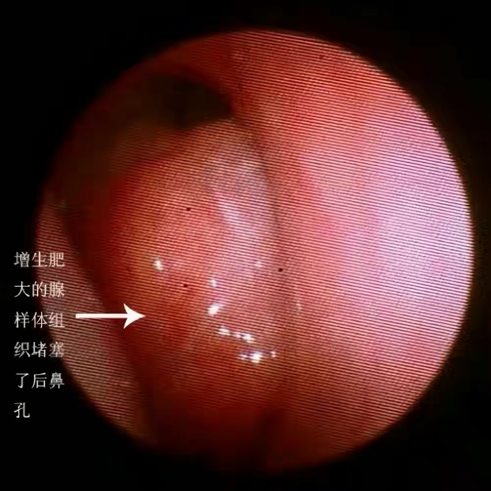 小儿腺样体肥大危害大，中医治疗有优势