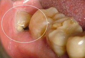 当智齿碰上牙髓炎，直接拔掉还是开髓后再拔掉？听听牙医的建议