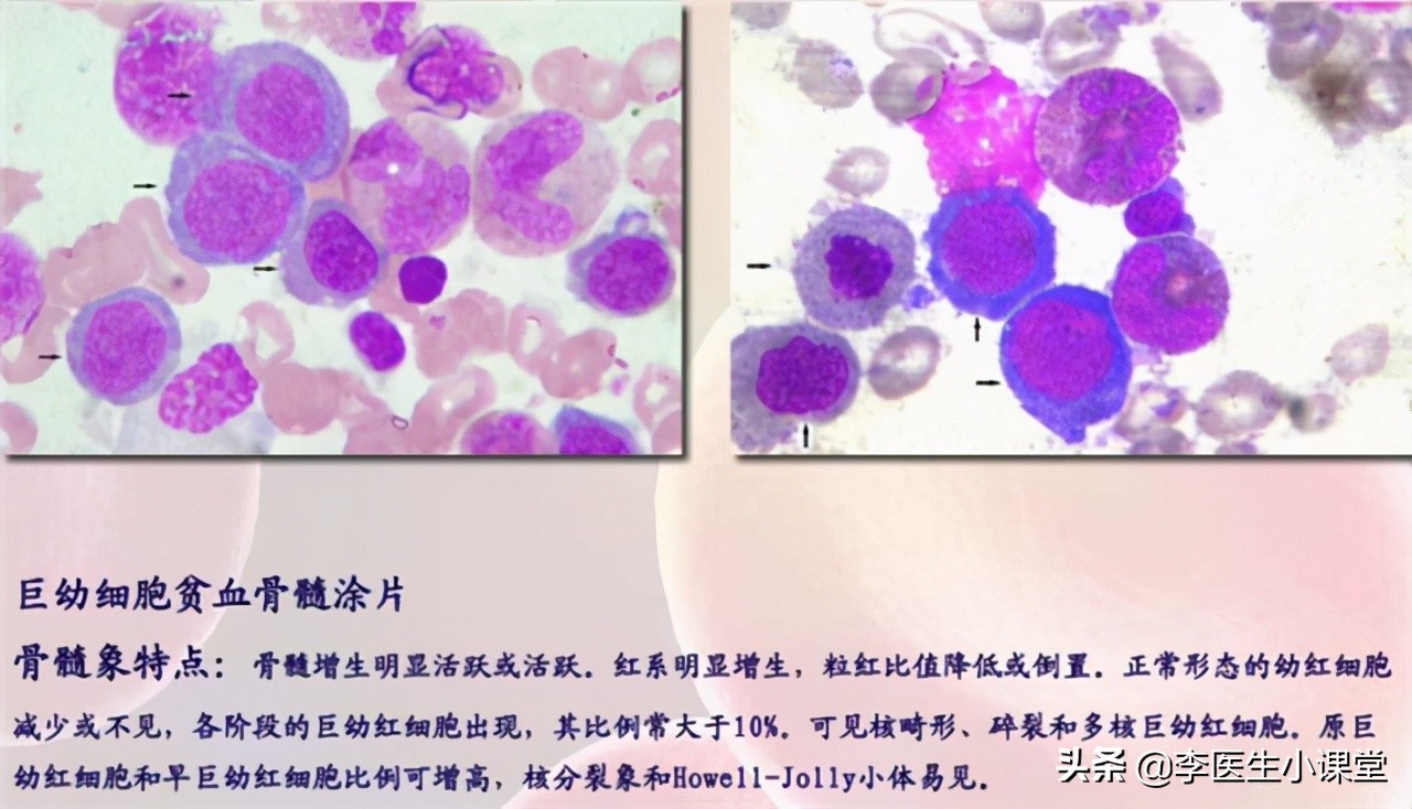 甲钴胺不仅能修复受损神经，还能用于这几种常见病的治疗，好用