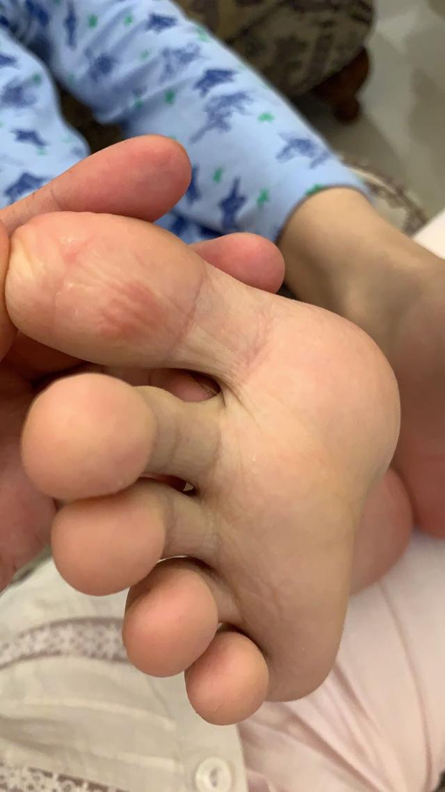 中医治疗中学生手汗脚汗症1例