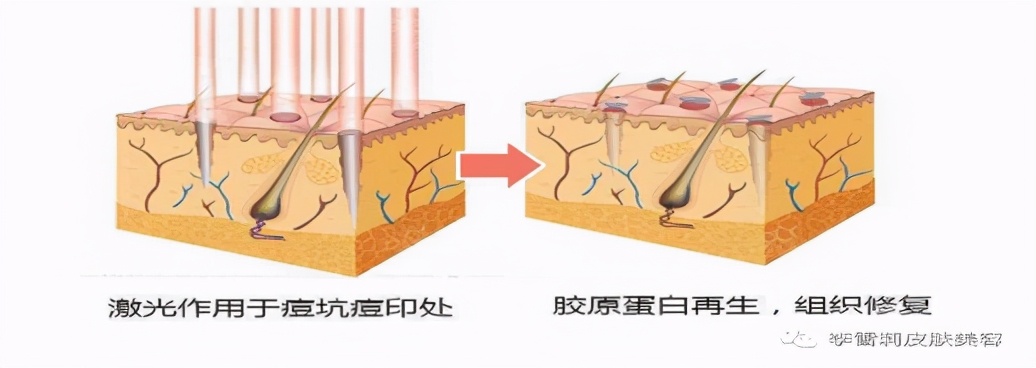 还在为痘坑苦恼吗？你可能还不知道这个痘坑“救星”